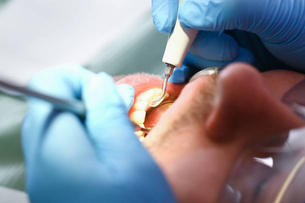 Best Emergency Root Canal Treatment in Homosassa, FL